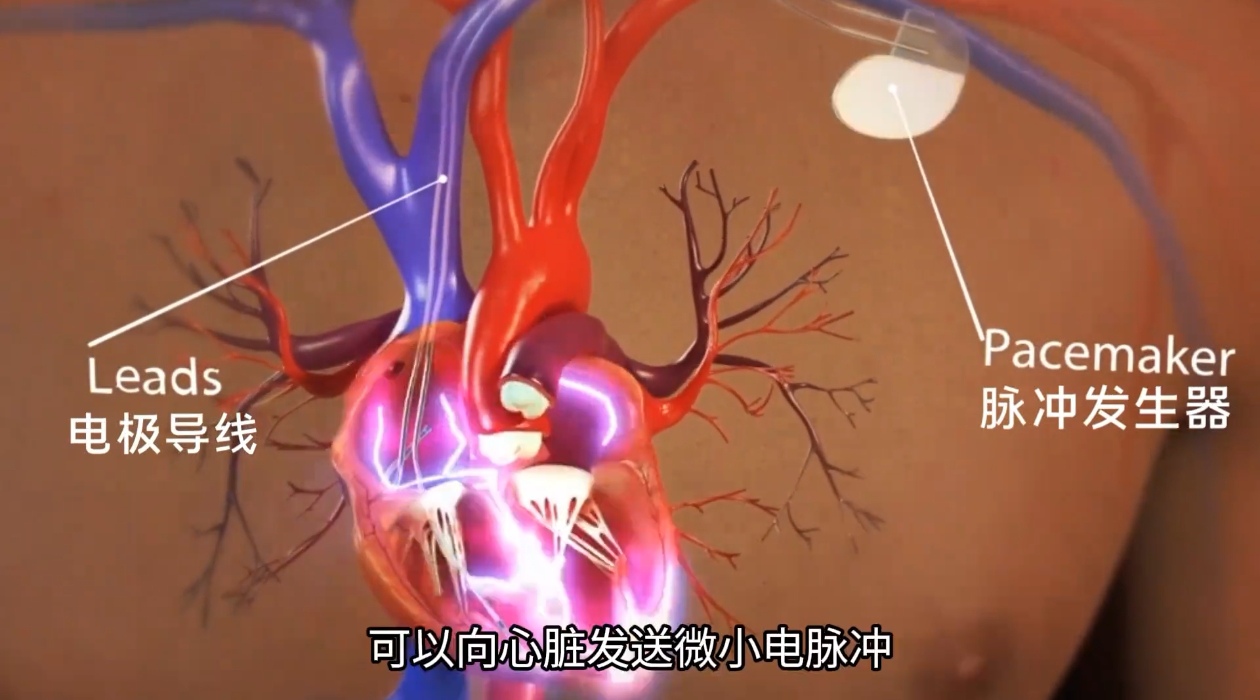 心臟起搏器 心臟起搏器